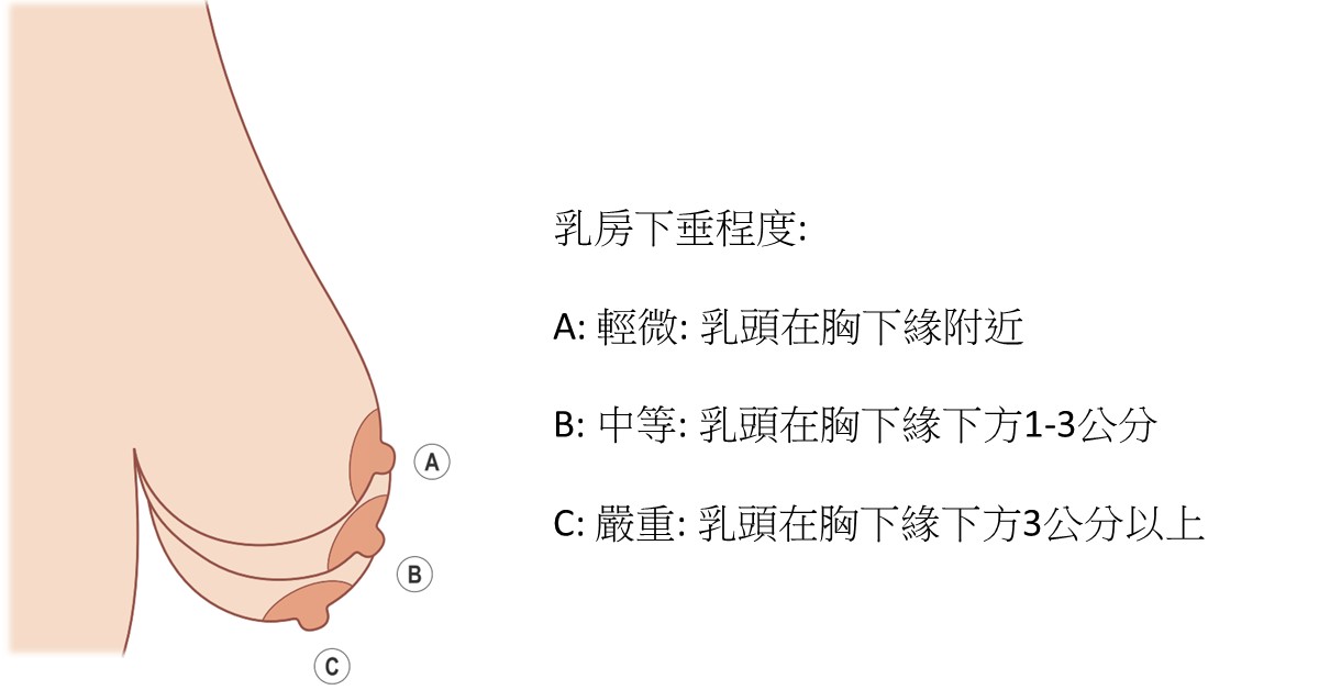 根据我个人的手术经验,我主要是依据乳房下垂的程度来参考.